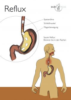 Reflux_Illustration_1